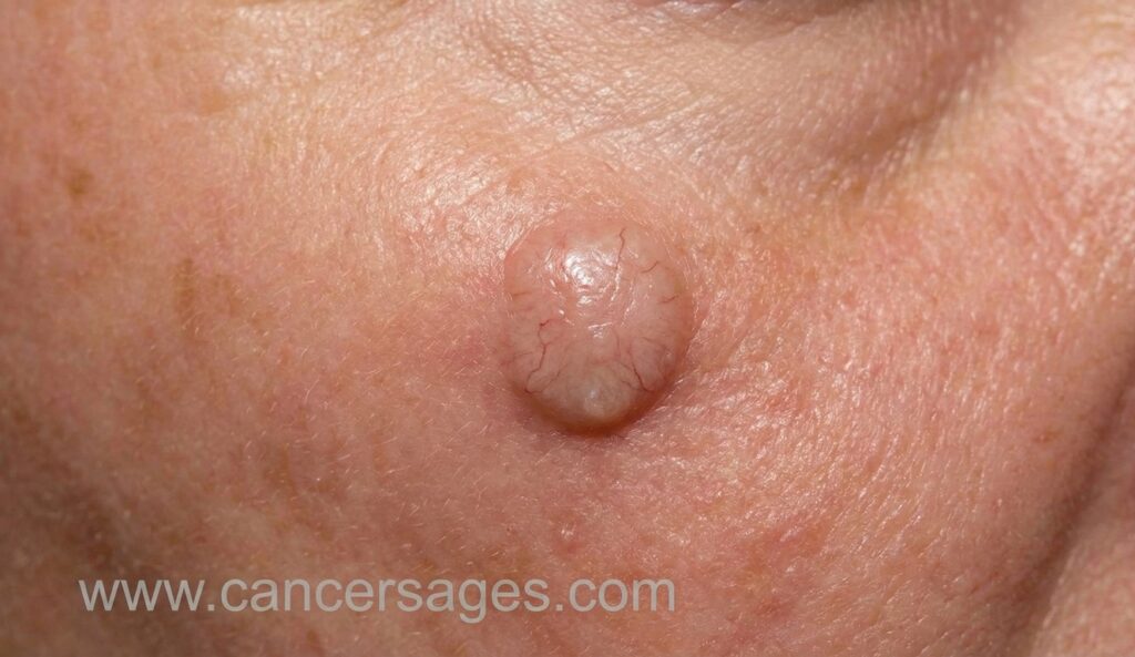 تصویر کارسینوم سلول بازال روی صورت (Basal Cell Carcinoma)