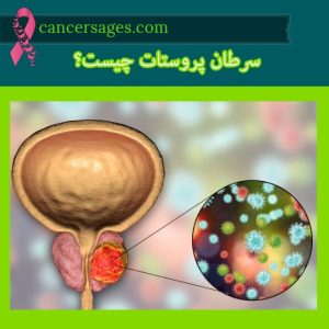 سرطان پروستات