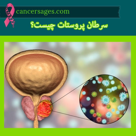 سرطان پروستات چیست؟