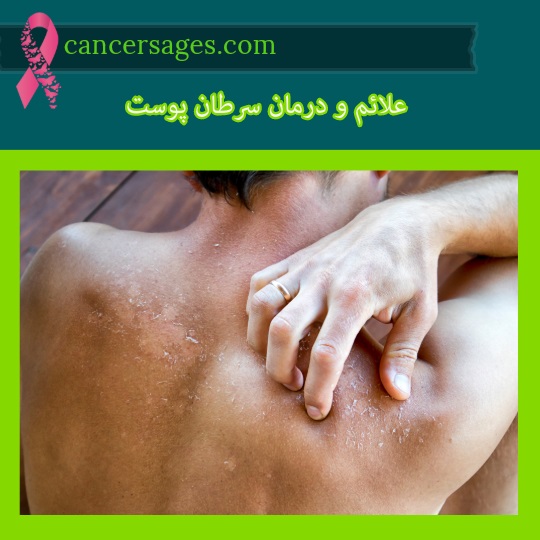 علائم و درمان سرطان پوست