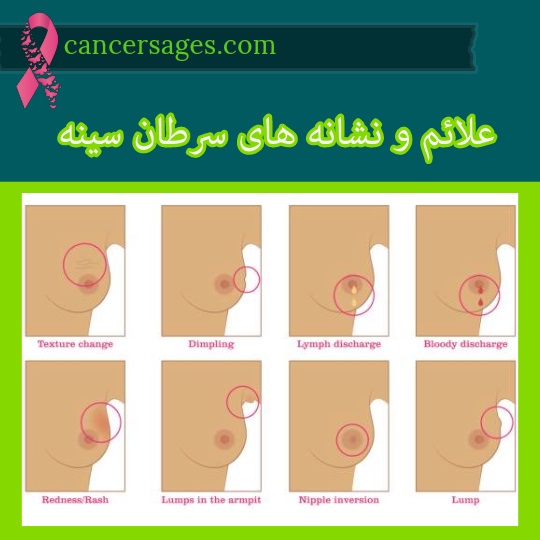 علائم و نشانه های سرطان سینه
