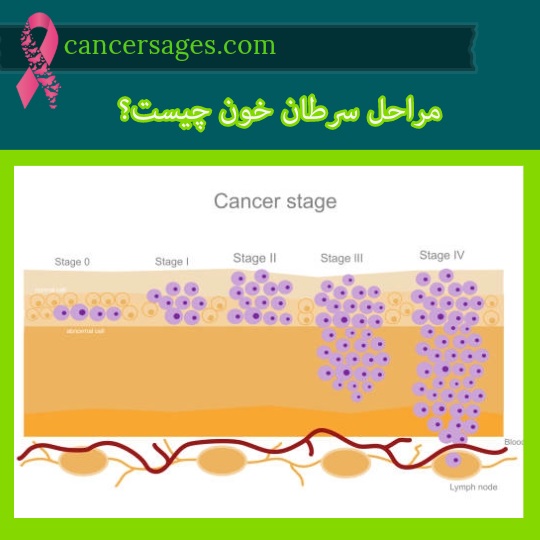 مراحل سرطان خون چیست؟