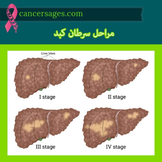 مراحل سرطان کبد