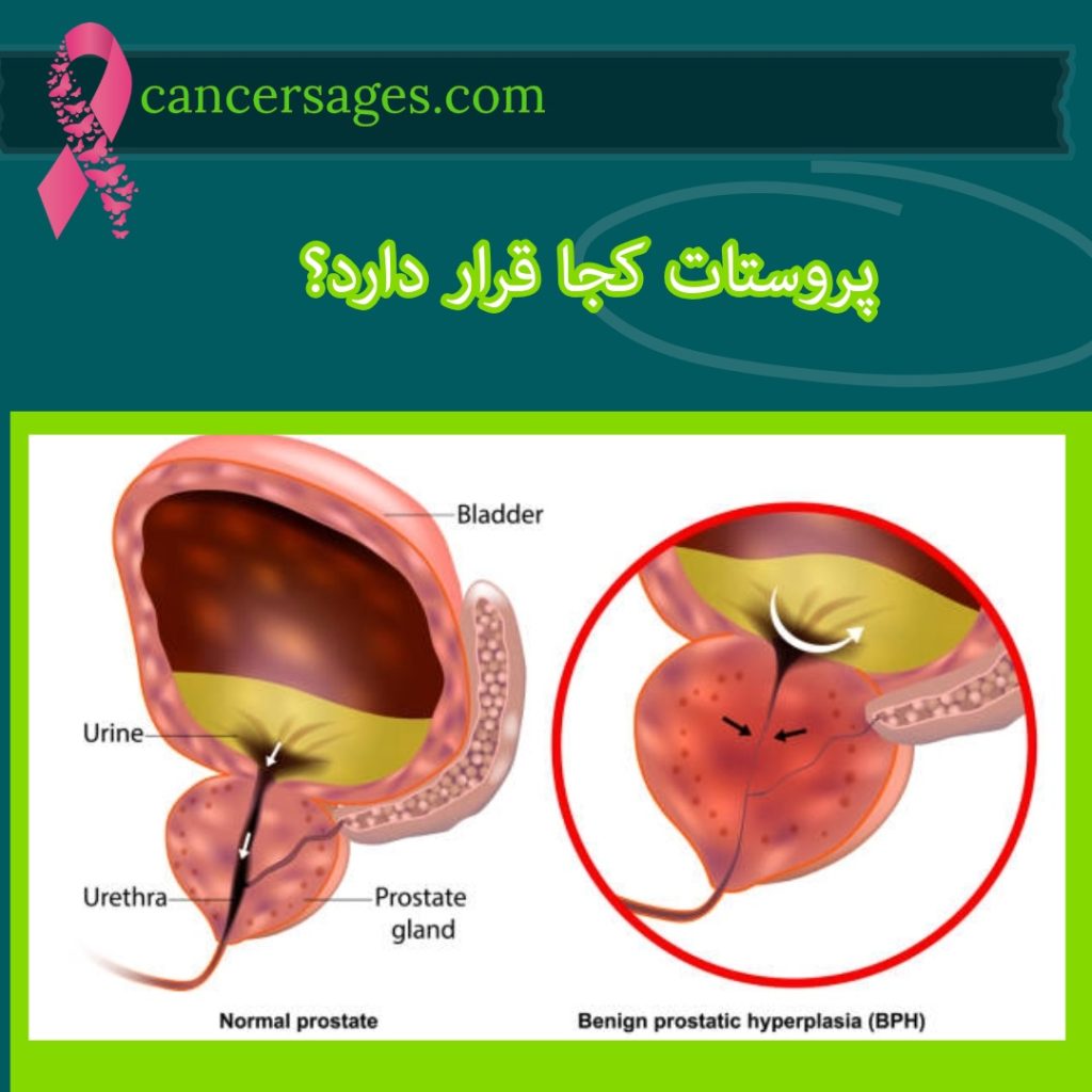 پروستات کجا قرار دارد