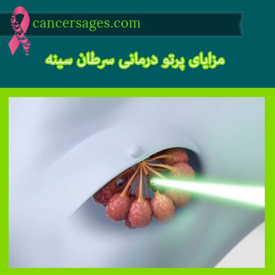 مزایای پرتو درمانی سرطان سینه