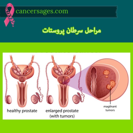 مرحله بندی سرطان پروستات اسیج بندی