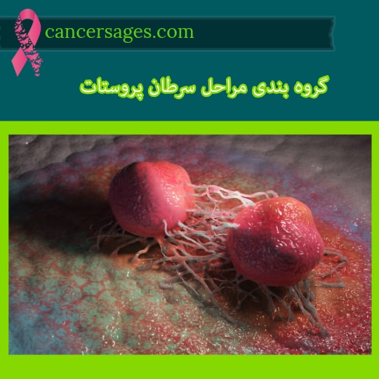 گروه بندی مراحل سرطان پروستات