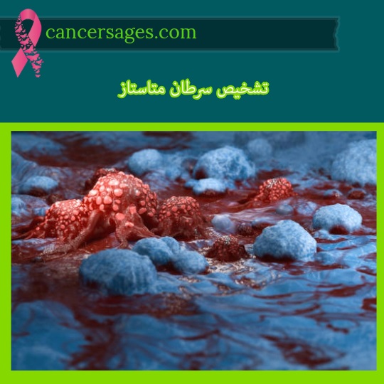 تشخیص سرطان متاستاز