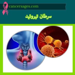 سرطان تیروئید