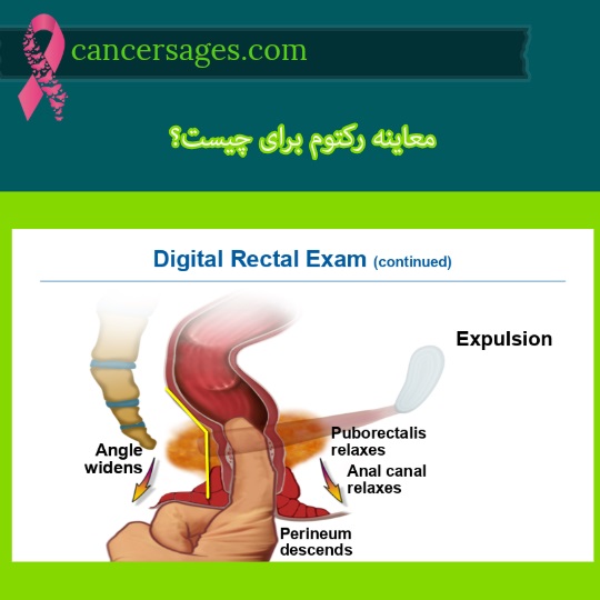 معاینه رکتوم برای چیست؟