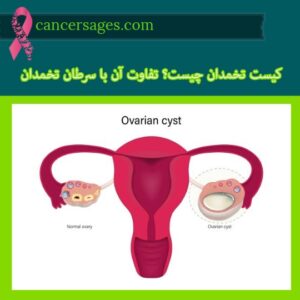 کیست تخمدان چیست؟ تفاوت آن با سرطان تخمدان