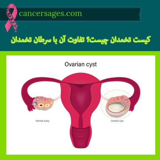 کیست تخمدان چیست؟ تفاوت آن با سرطان تخمدان