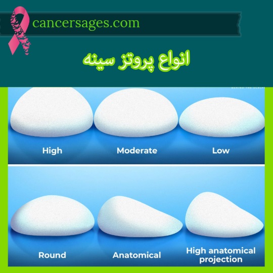 انواع پروتز سینه