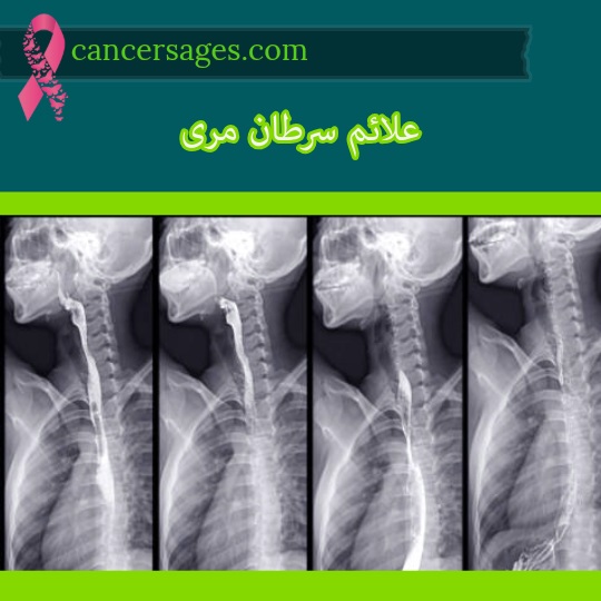 علائم سرطان مری