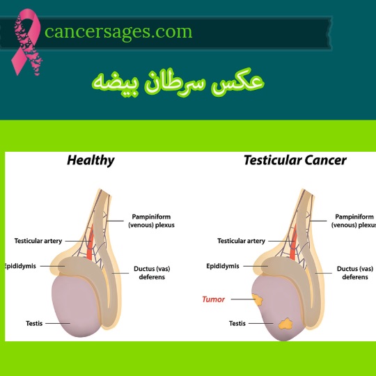 عکس سرطان بیضه