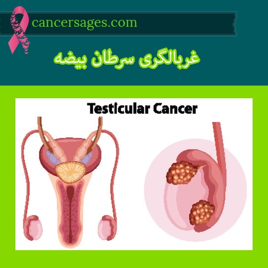 غربالگری سرطان بیضه