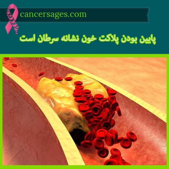 پایین بودن پلاکت خون نشانه سرطان است