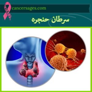 سرطان حنجره​