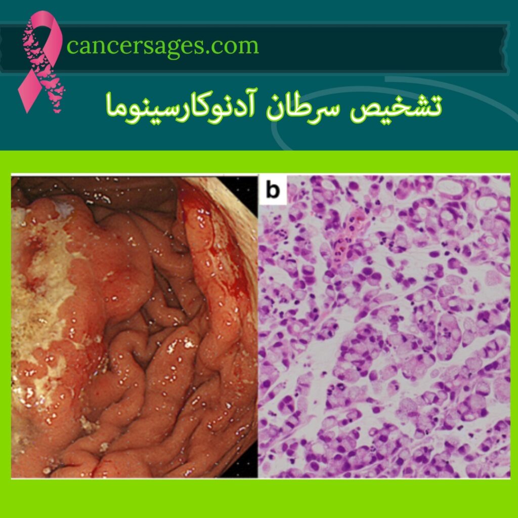 تشخیص سرطان آدنوکارسینوما