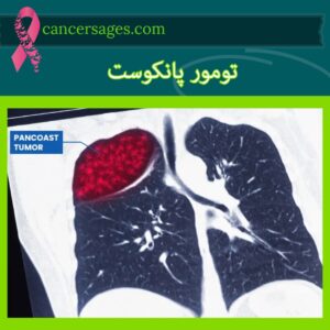سرطان ریه چیست؟ علائم و درمان سرطان ریه 22 تومور پانکوست