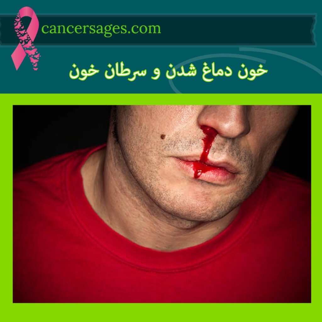 خون دماغ شدن و سرطان خون