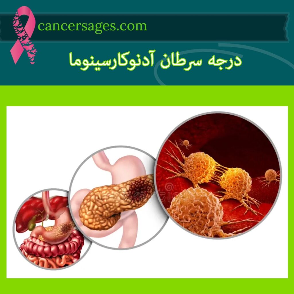 درجه سرطان آدنوکارسینوما