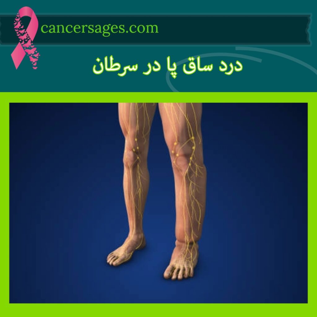 درد ساق پا در سرطان