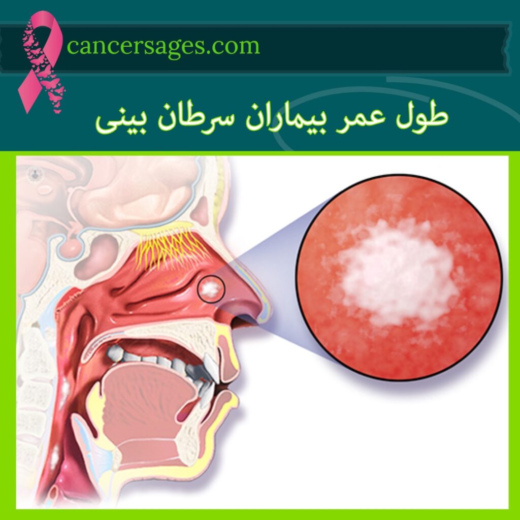 طول عمر بیماران سرطان بینی