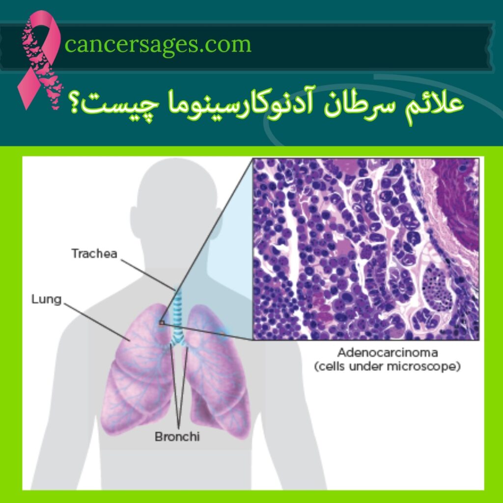 علائم سرطان آدنوکارسینوما چیست؟