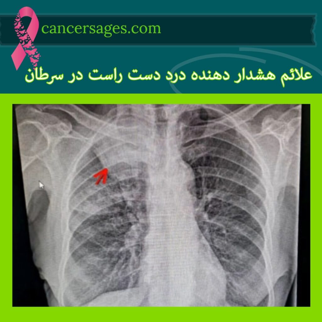 علائم هشدار دهنده درد دست راست در سرطان