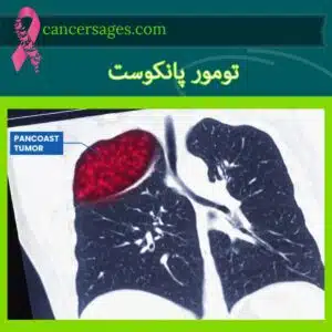 تومور پانکوست