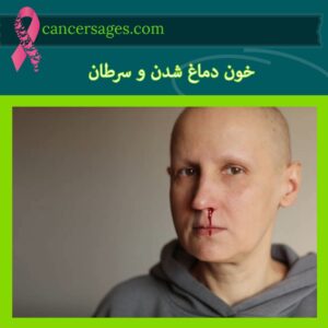 خون دماغ شدن و سرطان
