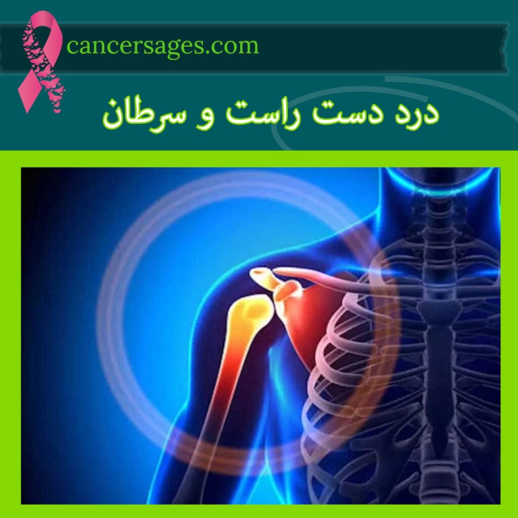 درد دست راست و سرطان