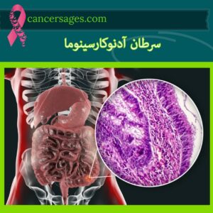 سرطان آدنوکارسینوما