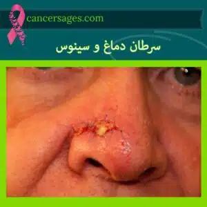 سرطان دماغ و سینوس