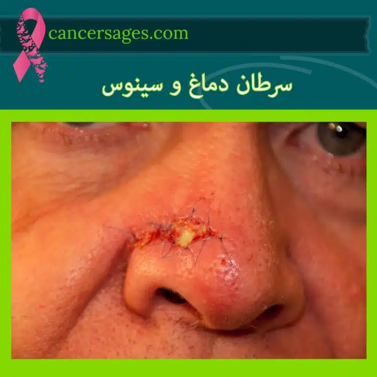 سرطان دماغ و سینوس