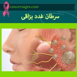 سرطان غدد بزاقی