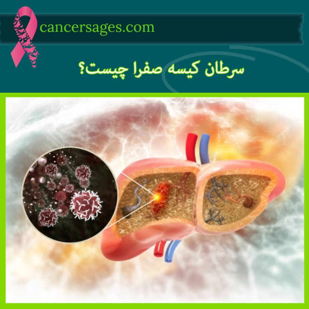 سرطان کیسه صفرا چیست