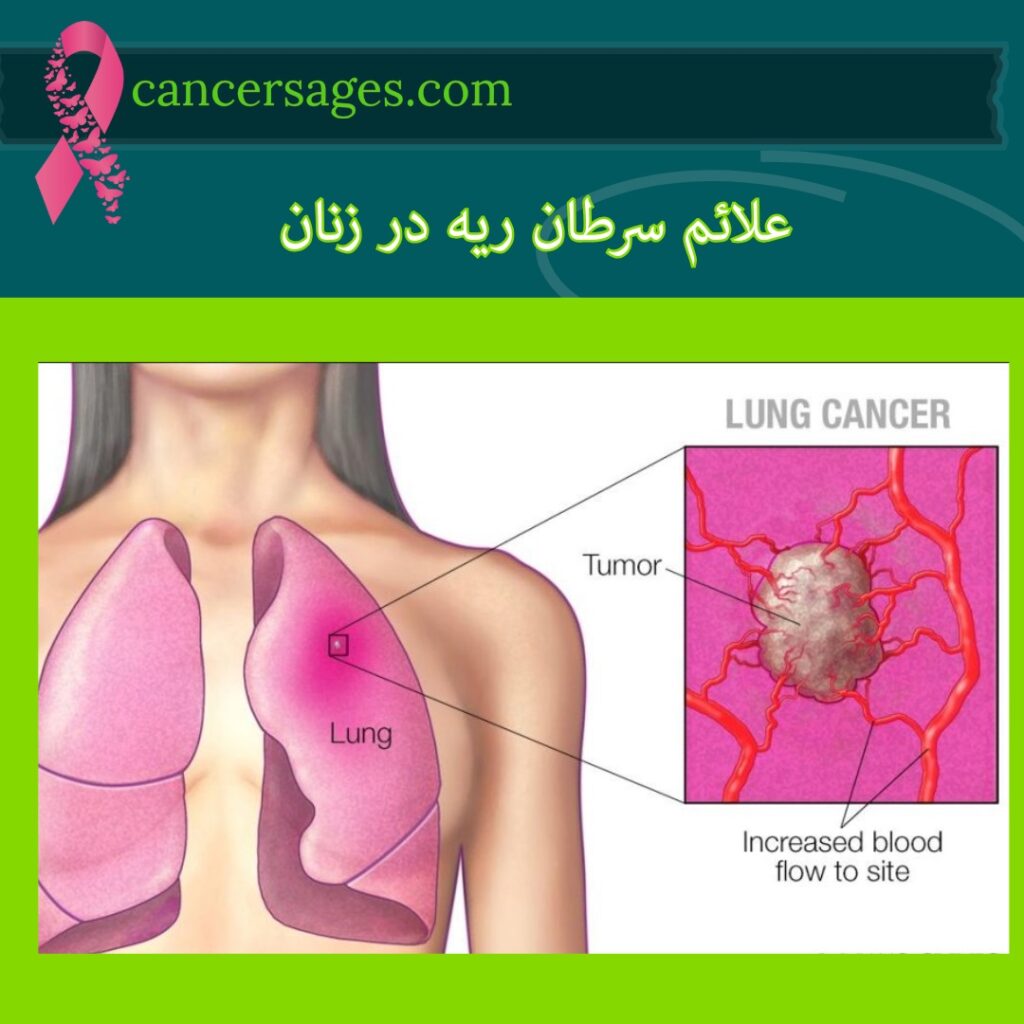 علائم سرطان ریه در زنان