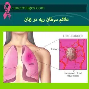 علائم سرطان ریه در زنان