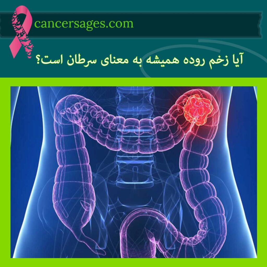 آیا زخم روده همیشه به معنای سرطان است؟