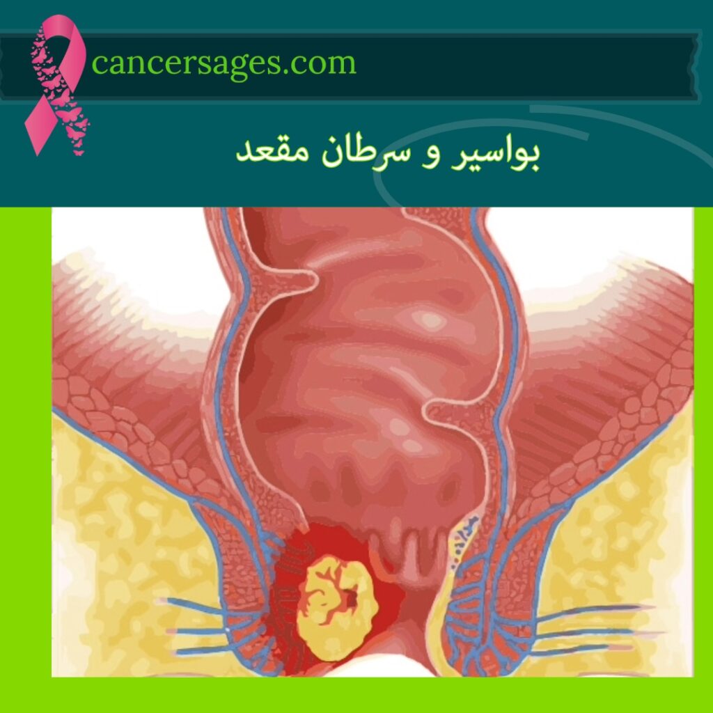 بواسیر و سرطان مقعد