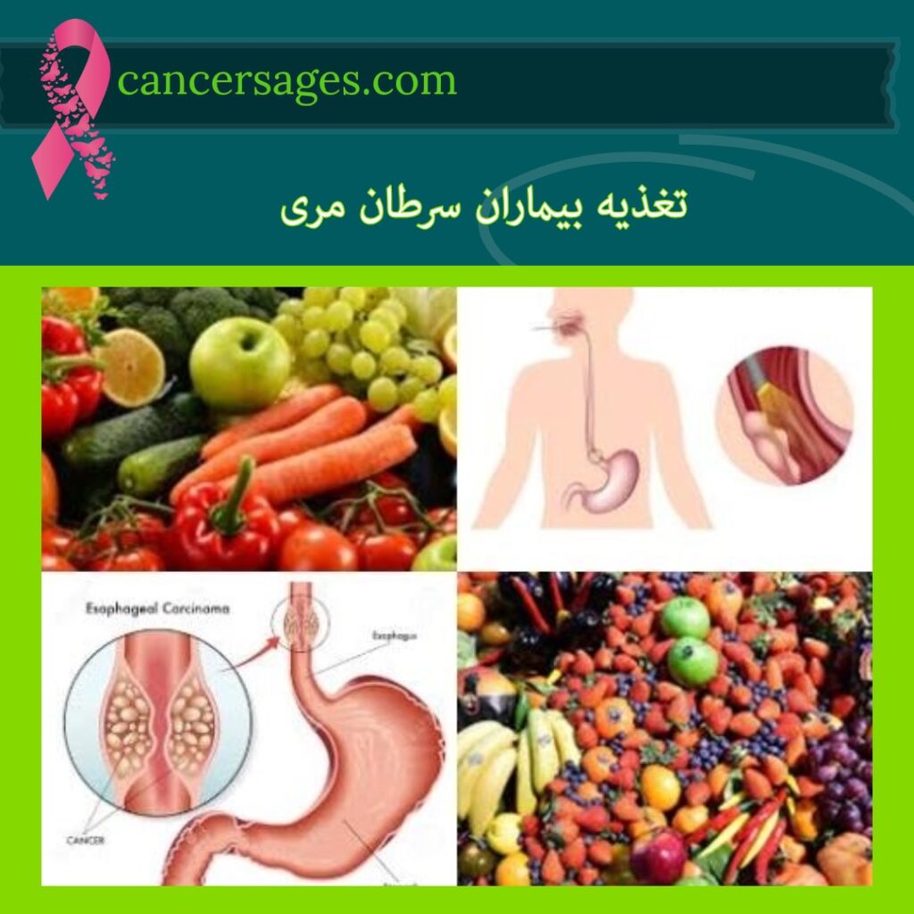 تغذیه بیماران سرطان مری