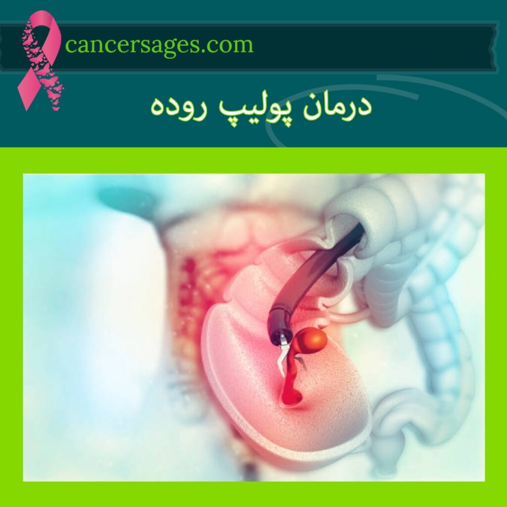 درمان پولیپ روده