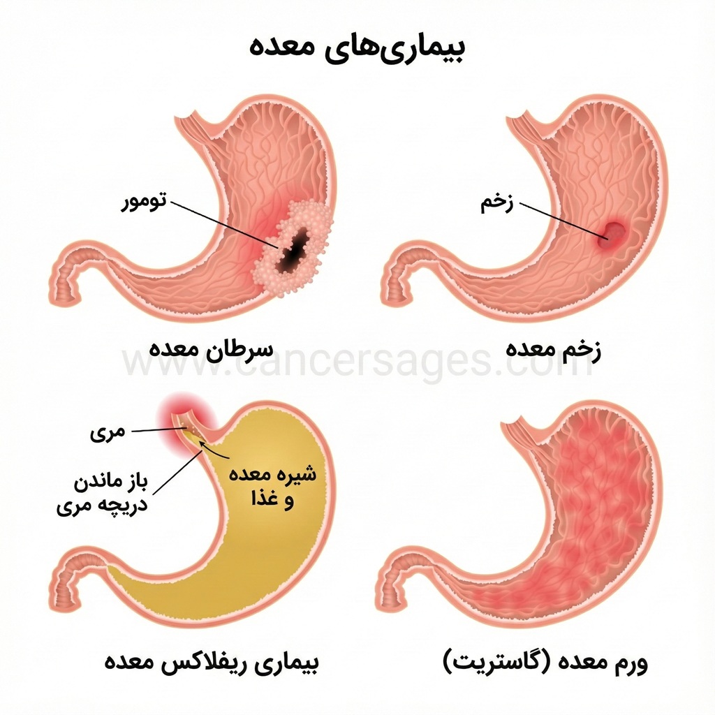 مهم‌ترین علائم و نشانه‌های هشداردهنده سرطان معده