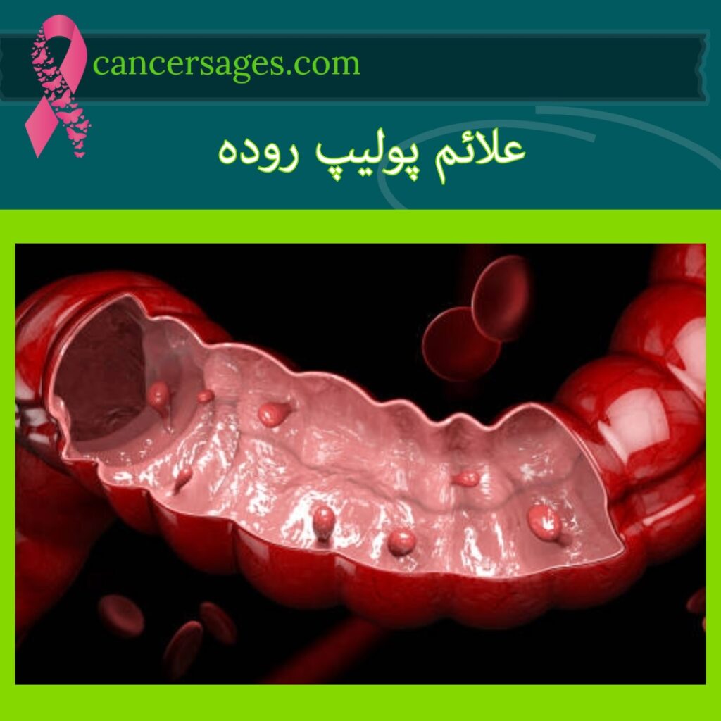پولیپ روده