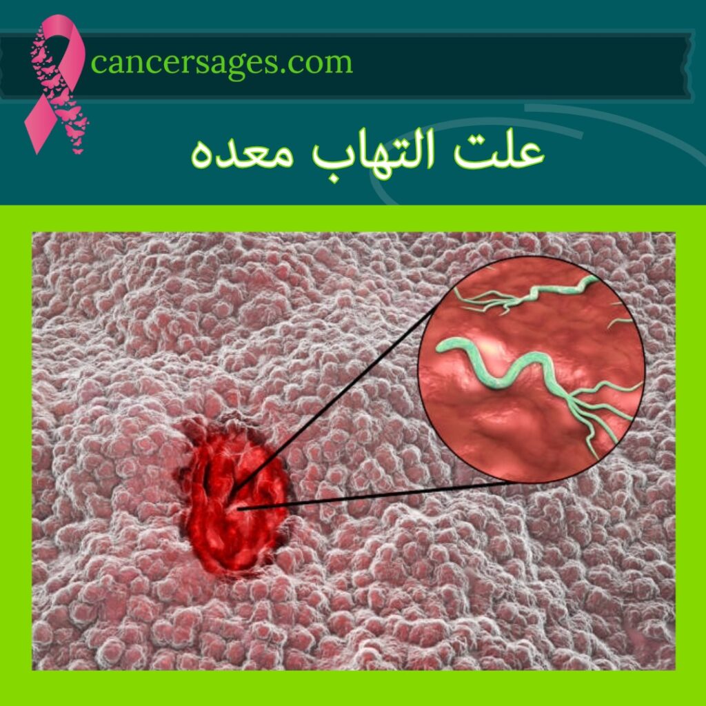 علت التهاب معده