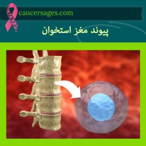 آنچه درباره سرطان خون باید بدانیم 13 پیوند مغز استخوان