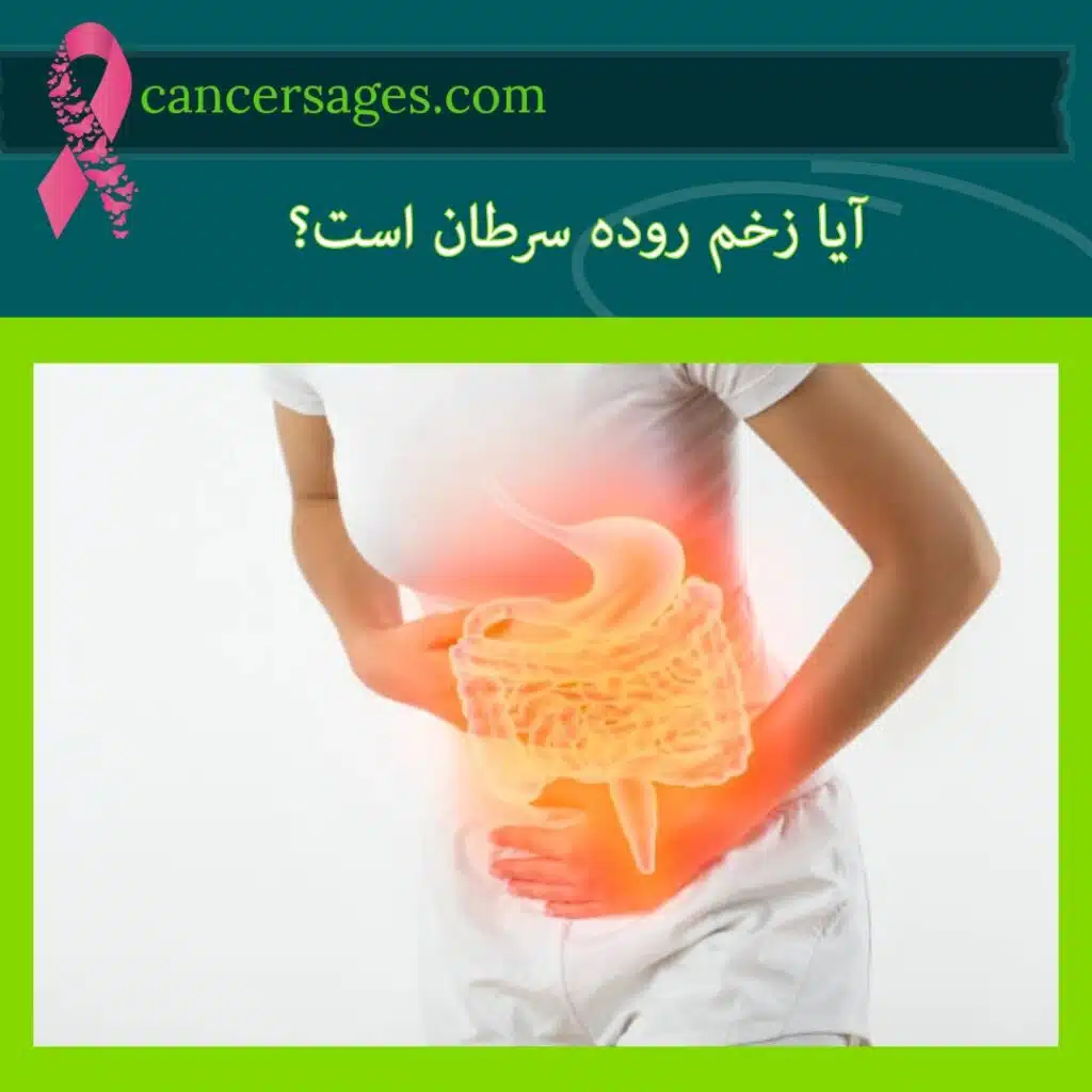 آیا زخم روده سرطان است
