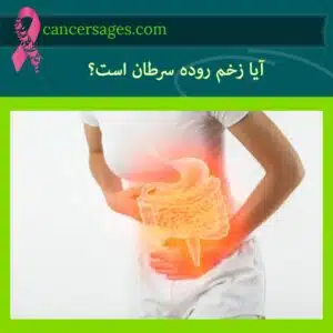 آیا زخم روده سرطان است